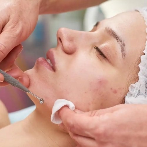 Acne facial
